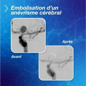 Radiographie d'une embolisation d'un anévrisme cérébral