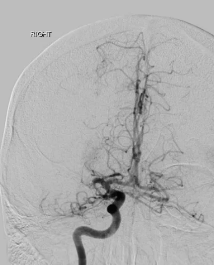 Angiographie cérébrale démontrant une occlusion de l'artère cérébrale moyenne droite