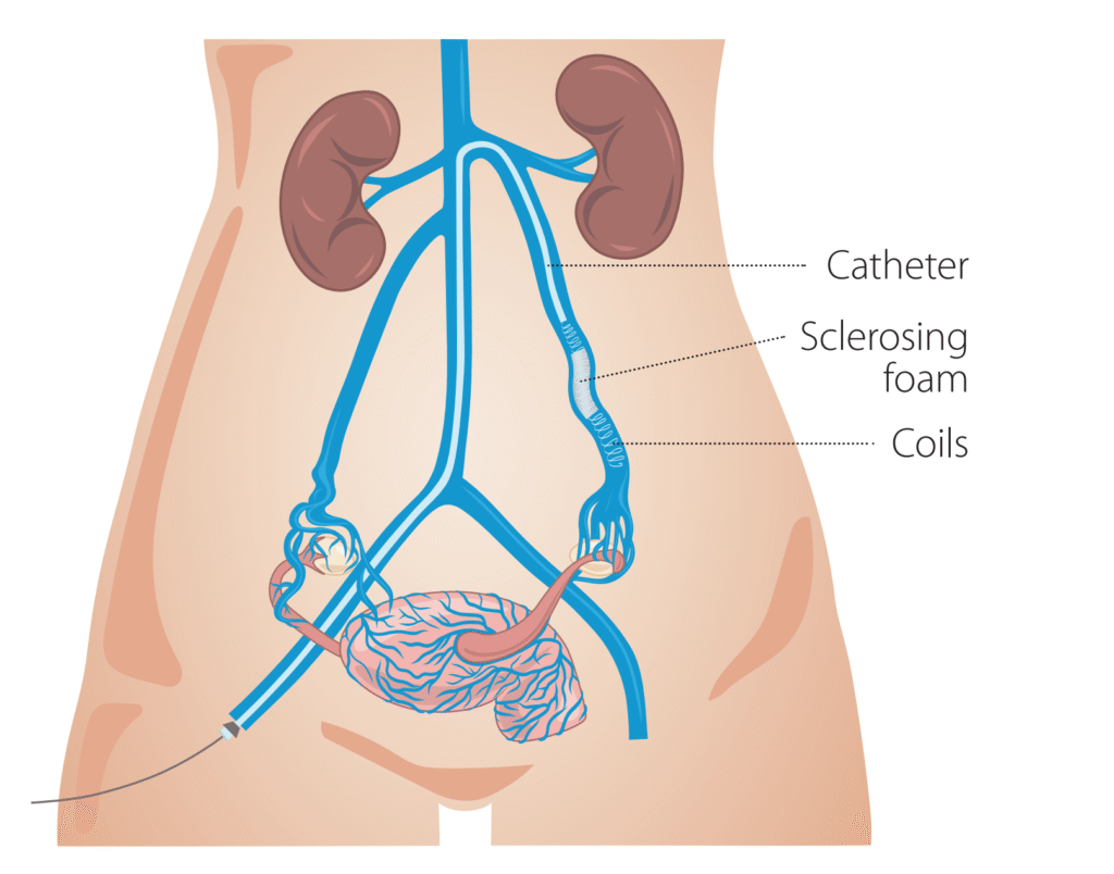 Schéma de l'opération des varices pelviennes