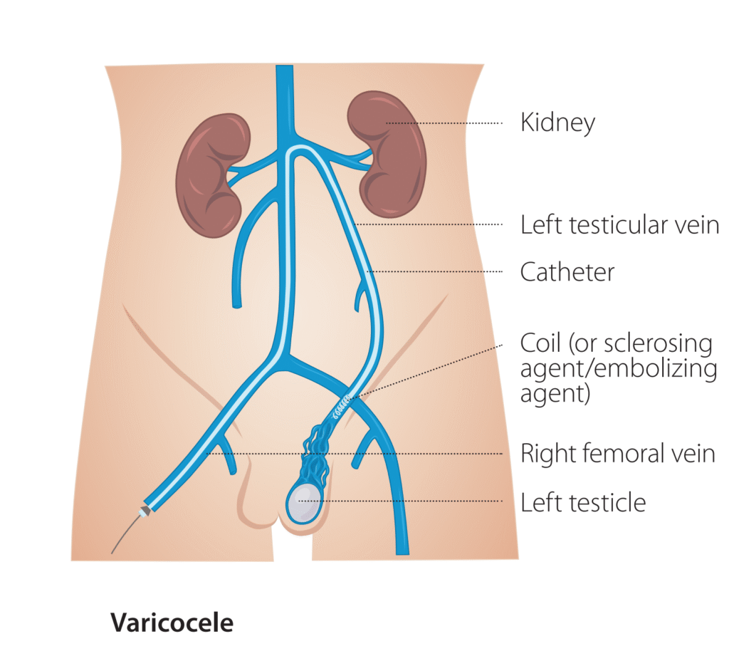 Schéma de traitement de varicocèle